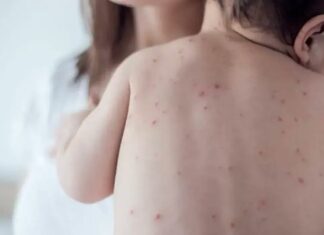 Alerta sanitaria: confirmaron ocho casos de sarampión en el AMBA y crece la preocupación