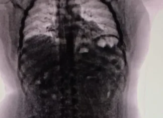 Cayó un narcotraficante con 90 cápsulas de cocaína en su cuerpo