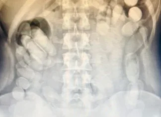 Narcotráfico: una mujer ingirió más de 100 cápsulas con cocaína