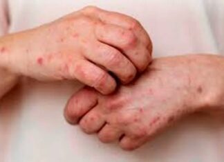 Córdoba: confirman dos nuevos casos de viruela símica