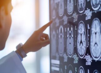 Los cinco síntomas que podrían indicar un ACV y nunca deben subestimarse, según un neurólogo